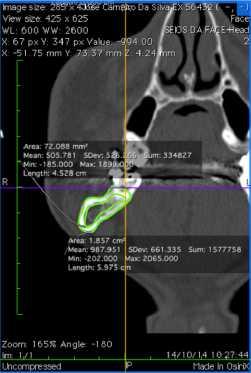 A B Figura 2: A- Avaliação da área de osso cortical e