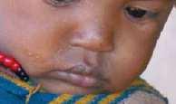 000) Em 2012: 242.885 internamentos por pneumonia em crianças < 5 anos (Coef.