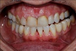 biocompatibilidade, longevidade, estabilidade de cor e propriedades mecânicas que biomimetizam o esmalte dentário 3.