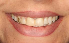 dental, possíveis falhas no término da moldagem e escolha da cerâmica de acordo com o substrato a ser trabalhado e o protocolo de cimentação 1.