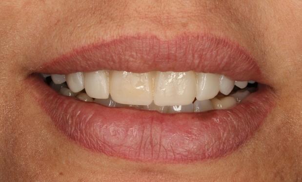 Na sequência, foram realizados três sulcos de orientação na face vestibular do dente, no sentido cervico-incisal, levando-se em consideração a inclinação da superfície vestibular.