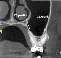 Essas manobras vão projetar a anatomia interna para a superfície externa da coroa. 083 C D 04.