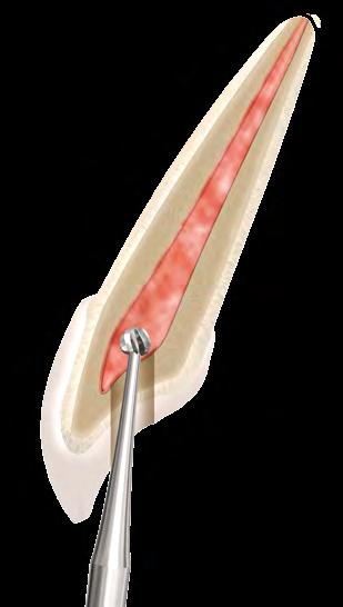 DIREÇÃO DE TREPNÇÃO Consiste no desgaste de dentina em direção à área de maior volume da câmara pulpar.