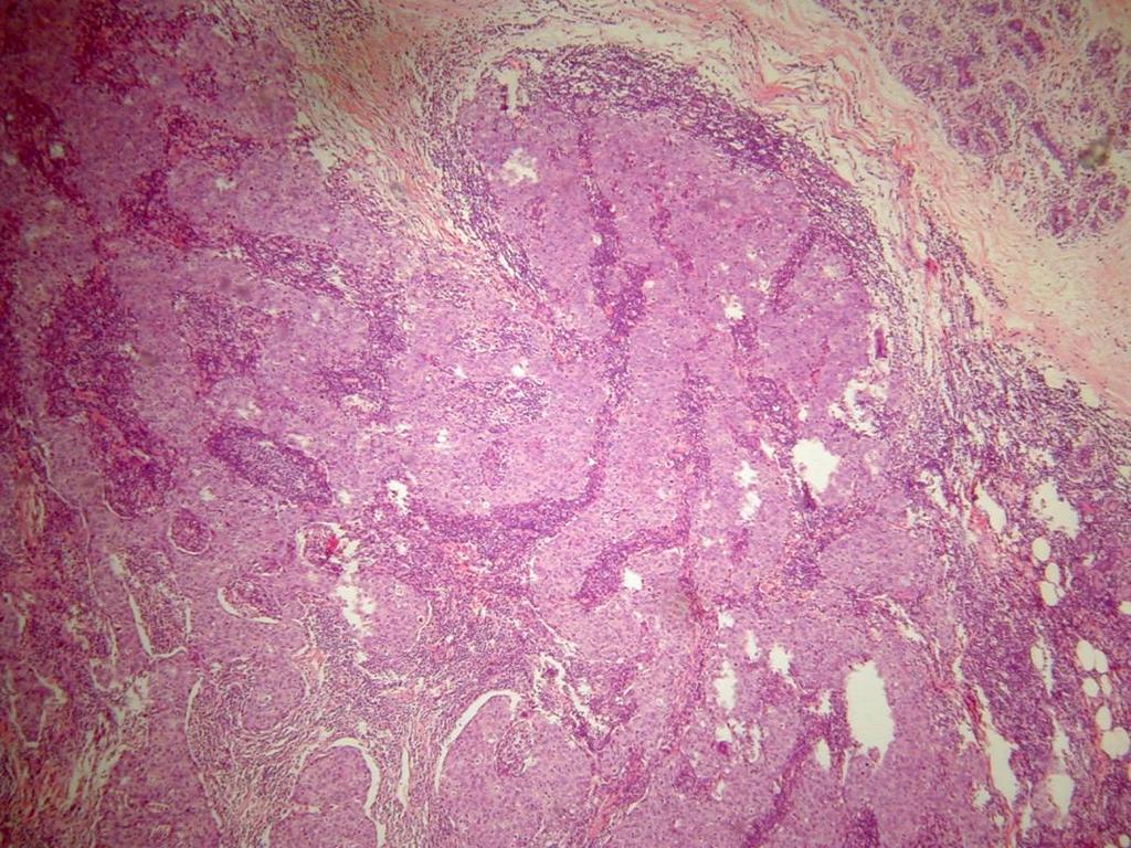 Pacientes e Métodos Figura 7- Contorno tumoral parcialmente circunscrito (hematoxilina-eosina-aumento microscópico original 40x).