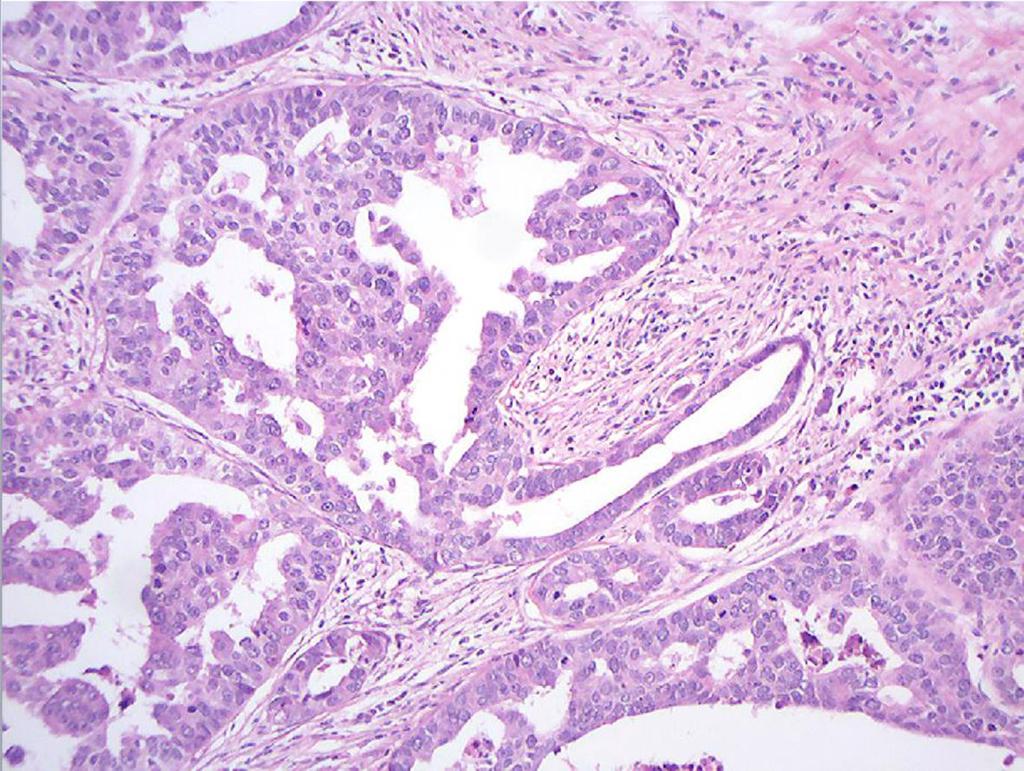 Pacientes e Métodos Figura 14 - Formação de túbulos Intensa (hematoxilina-eosina-aumento microscópico original 200x). 4.