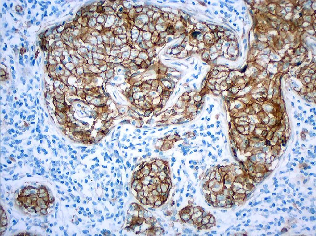 Pacientes e Métodos Figura 16 - Expressão tumoral de catenina-beta, padrão