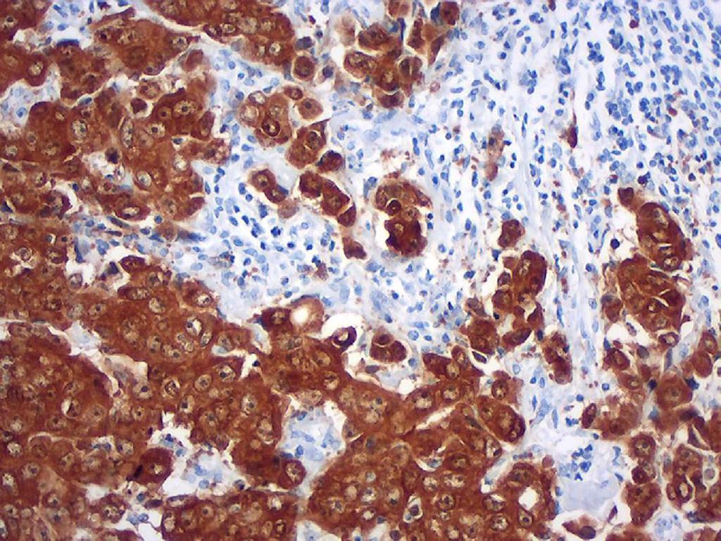 Pacientes e Métodos Figura 17 Expressão tumoral de p16 (imunoistoquímica aumento microscópico original 200x).