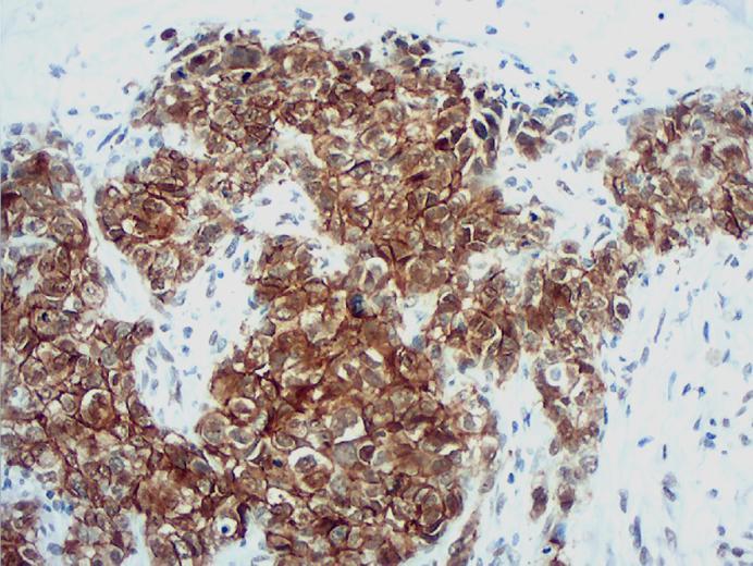 Pacientes e Métodos Figura 20 - Expressão tumoral de claudina 7, padrão membrana (imunoistoquímica aumento microscópico original 200x).