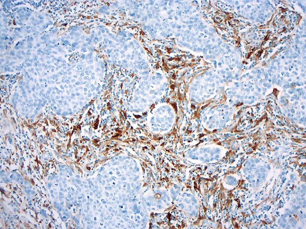 Pacientes e Métodos Figura 22 - Expressão de ALDH1 em células estromais e