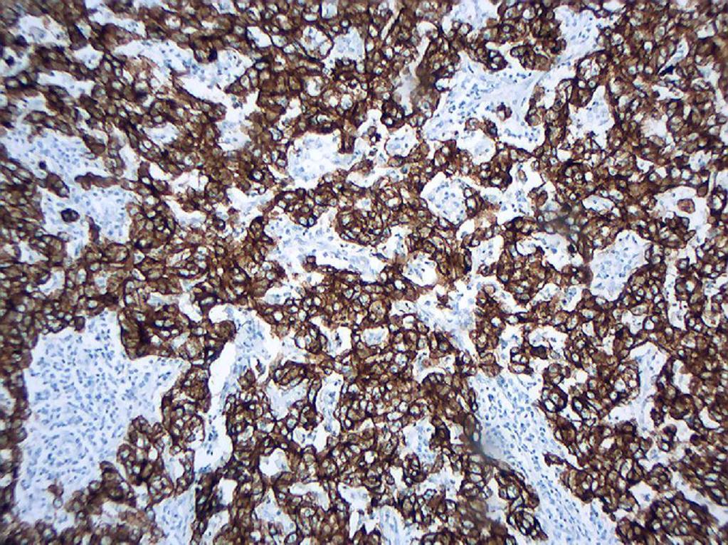Pacientes e Métodos Figura 23 - Expressão tumoral de citoqueratinas (imunoistoquímica aumento microscópico original 200x).