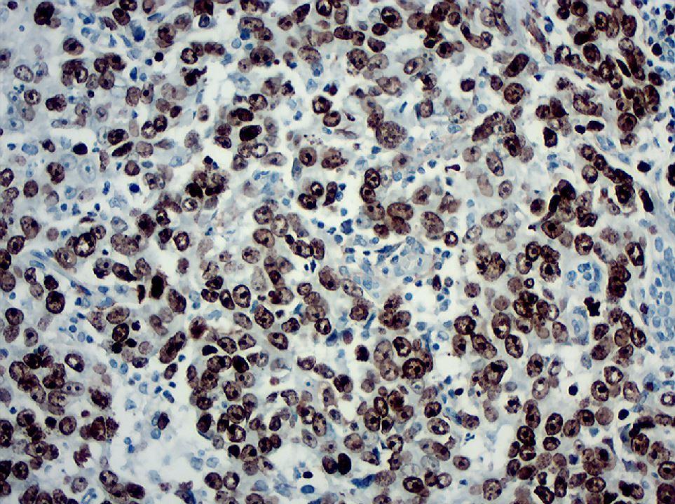 Pacientes e Métodos Figura 25 Neoplasia com alta atividade proliferativa marcação nuclear em células neoplásicas para Ki 67 de 95% (imunoistoquímica aumento microscópico original 400x).