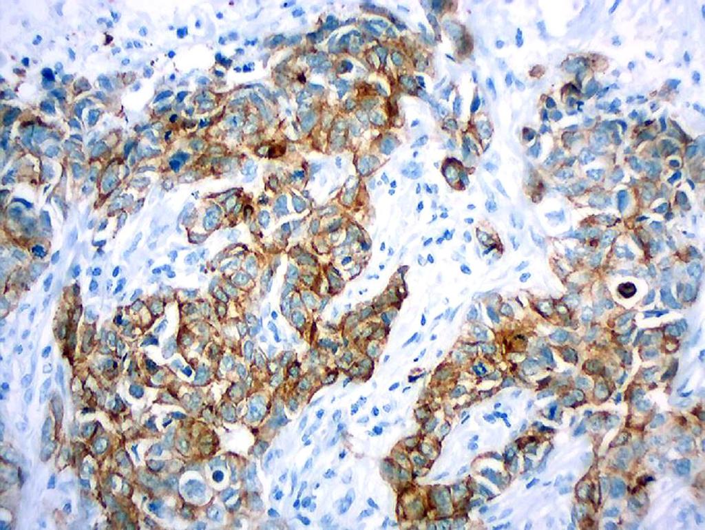 Pacientes e Métodos Perfil de células tronco: ALDH1 positivo Figura 26 - Marcação