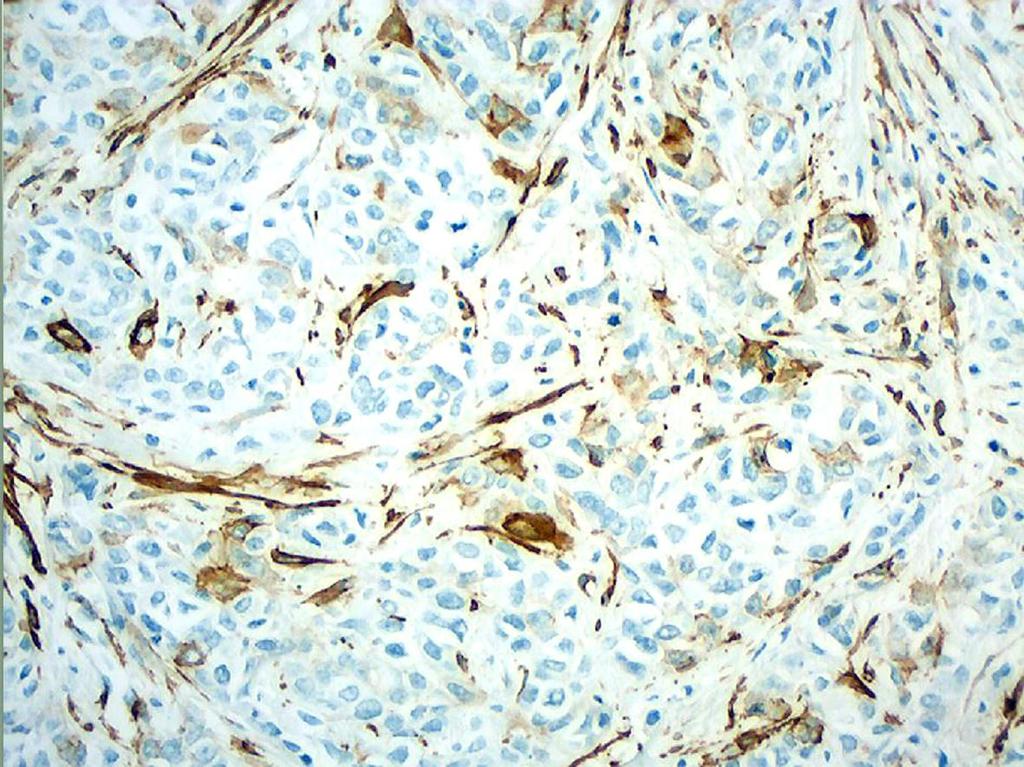 Pacientes e Métodos Figura 31 - Expressão tumoral de actina de músculo liso em células neoplásicas esparsas.