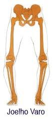 Desequilíbrio muscular: Quadril - alongar os músculos abdutores e fortalecer os