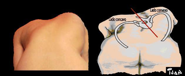 Tipos de escoliose: em C (simples ou total) e em S.