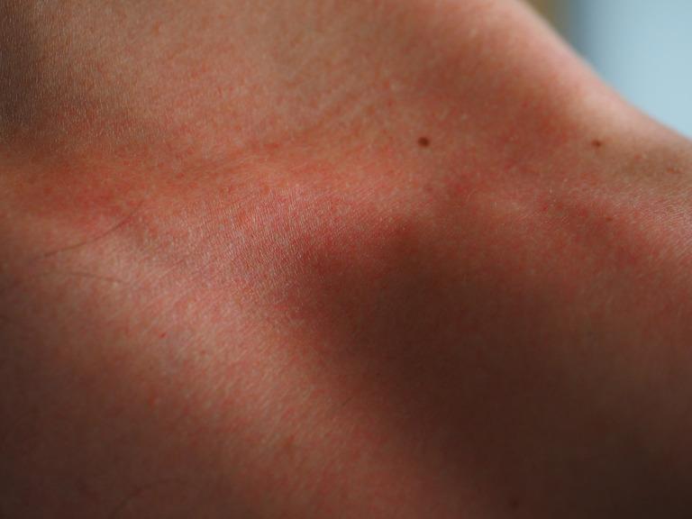 Como a pele reage à (d)epilação? Após a (d)epilação, a pele pode ficar avermelhada e sentir-se ligeiramente aquecida.