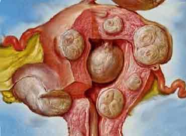 do útero, sendo o tumor sólido
