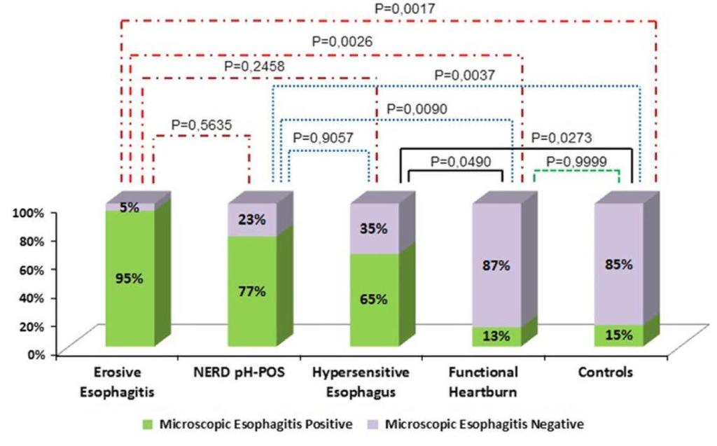 Endoscopia Digestiva Alta Papel da Biópsia Consenso de Lyon 2018 Esofagite eosinofílica DRGE não erosiva x Pirose funcional Htx / ME: Dilatação dos espaços intercelulares Gyawali CP, et al.