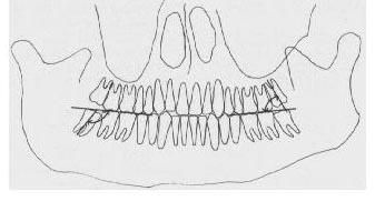 Proffit (1991) já acreditava que o crescimento tardio mandibular seria o principal responsável pelo apinhamento antero-inferior, e que a conduta de exodontia dos terceiros molares poderia diminuir a
