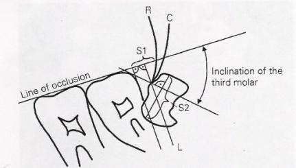 49 parcialmente na região caudal do ramo mandibular; c) espaço deficiente: quando o processo alveolar termina na distal do segundo molar inferior e o terceiro molar dentro do segmento caudal do ramo