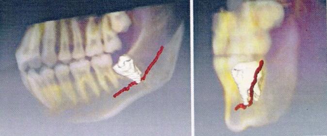 61 grau na angulação do terceiro molar inferior com o plano oclusal aumenta a impactação em até 11%.