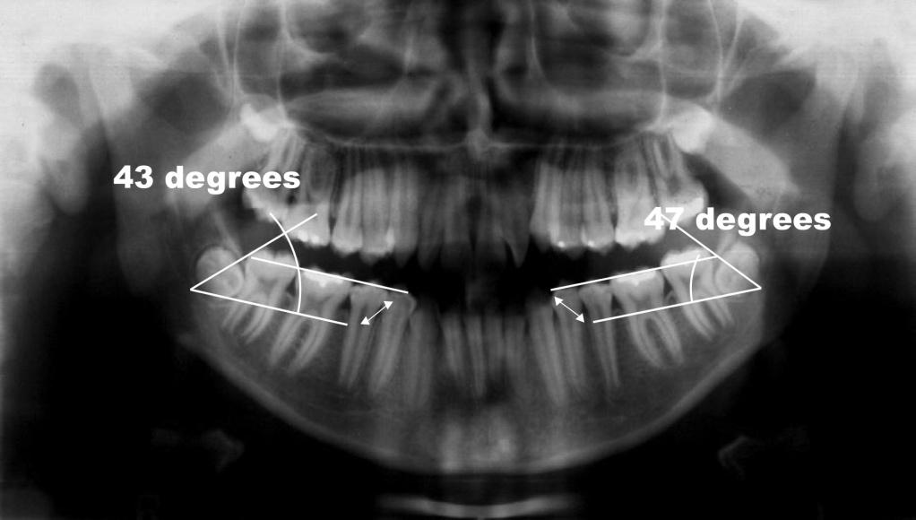66 Figura 32 - Radiografia panorâmica indicando a medida angular dos terceiros molares inferiores esquerdo e direito levando em consideração o longo eixo destes com o plano oclusal do primeiro molar