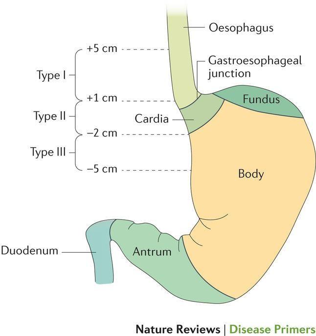 Introdução Adenocarcinoma do esófago distal e da JEG ESMO Oesophageal Cancer Guidelines Adenocarcinoma