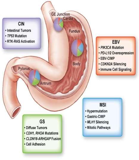 Subtipos moleculares e eventuais biomarcadores 295 patients with primary gastric cancer : 50% chromosomal