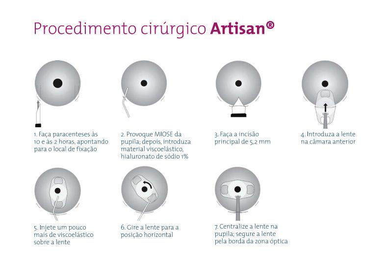 Como é feito o implante de Artisan? Sob anestesia local, a lente Artisan é implantada através de uma pequena incisão na extremidade da córnea.
