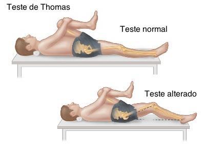 Testes musculares Testes de comprimento muscular Resultado: Encurtamento bilateral ou unilateral não se mantém ou não alcançam esta posição.
