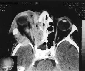 Na fossa craniana média, provável extensão tumoral para o seio cavernoso foi notada em três casos (rabdomiossarcoma do seio etmoidal, adenocarcinoma do seio maxilar e estesioneuroblastoma da fossa