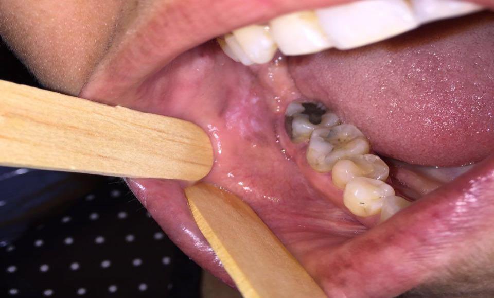 Ao exame intrabucal foi observada placa esbranquiçada, com áreas eritematosas, localizada em borda lateral de língua (Figura 1) e em mucosa jugal bilateral (Figura 2) lisa, com limites difusos, de