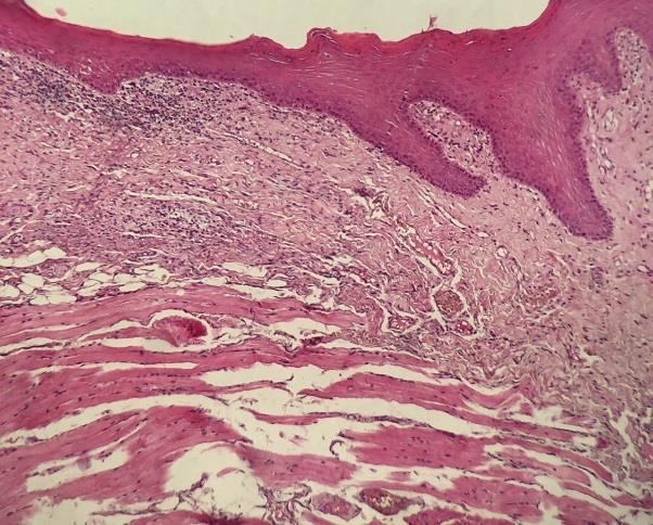 Os cortes histológicos revelam fragmentos de mucosa revestidos por epitélio pavimentoso queratinizado, com áreas de atrofia e discreta acantose. (Figura 3).