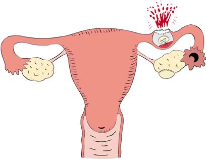é fora do útero e tem como consequência a ruptura da