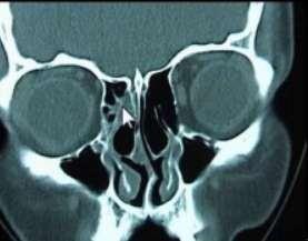 5) Paciente com rinossinusite crônica. Não apresenta causas obstrutivas (exceto um desvio septal muito discreto).