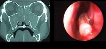 Cefuroxima TRATAMENTO CIRÚRGICO Uma vez tratado o quadro agudo, devemos investigar e tratar a etiologia da doença crônica.