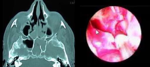 O pólipo, por ser uma massa que preenche todo o espaço do seio, dificulta a chegada de antibióticos na cavidade e, por isso, é um obstáculo ao tratamento clínico.