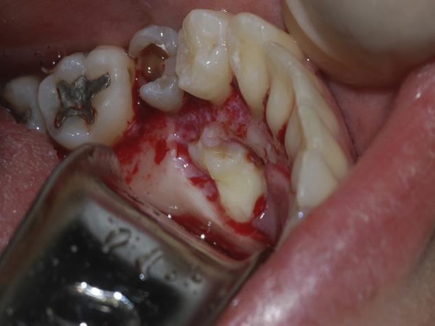 254 r e v p o r t e s t o m a t o l m e d d e n t c i r m a x i l o f a c. 2 0 1 2;5 3(4):252 257 Figura 4 Exposição da lesão. Figura 6 Espécime cirúrgico dos dentículos do odontoma.