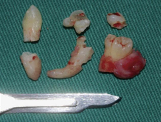 Foi realizada a incisão do tipo envelope na região lingual envolvendo os dentes 31 a 36.
