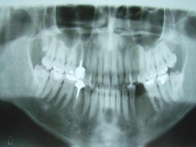 Túbulos dentinários e tecido pulpar constituído por tecido conjuntivo fibroso frouxo vascularizado, contendo odontoblastos (c) (aumento de 100 ).