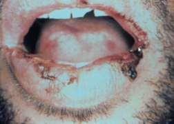 Imagem: Lesão de aspecto roído, difusa, espalhada pelo lábio inferior. Até provem o contrário, é um caso de Leishmaniose.