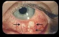 Pode haver formação de uma abscesso corneano, que dificulta a visualização do contorno da pupila, associado à vermelhidão.