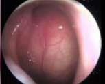 ou da tonsila palatina (obstrui mecanicamente a tuba auditiva), adenoidites e sinusites; Imagem: a primeira imagem mostra uma nasofibroscopia de um indivíduo normal.