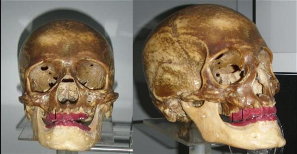 A B Figura 2. Regiões avaliadas. A. Incisivos e canino superiores. B. Pré-molares e molares superiores. C. Incisivos, canino, pré-molares e molares inferiores. C 4.