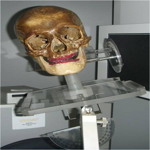 Já para avaliar a influência da inclinação lateral da cabeça foram realizadas mais duas aquisições, estando o crânio com seu longo eixo longitudinal inclinado lateralmente em ângulos de 10 e 20,