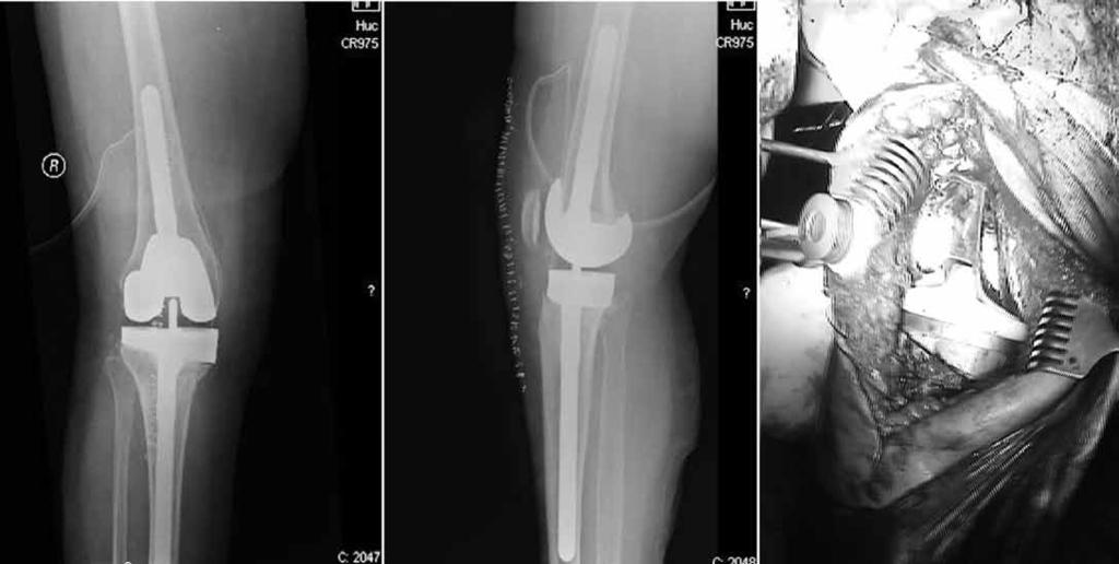 joelho 747 Figura 2 ATJ com fratura da haste tibial.