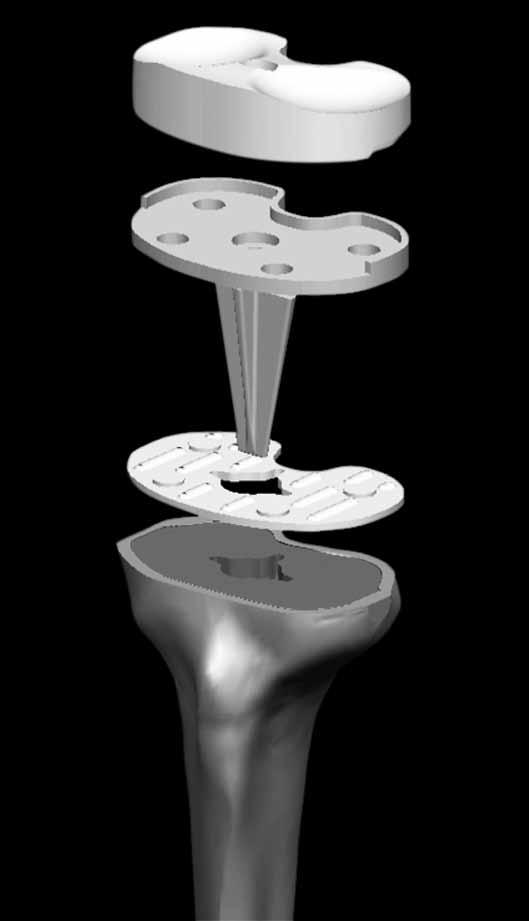 Fratura periprotética da tíbia combinada com fratura de fadiga da haste tibial de artroplastia total do joelho 749 Figura 6 Modelo prótese em elementos finitos mostrando uma alta concentração de