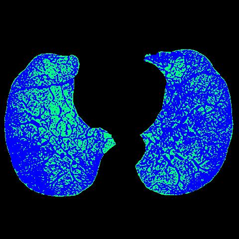 CPAP effects on regional lung aeration in COPD patients: a HRCT study Hiperaeração <-950UH Without CPAP CPAP of 5cmH 2 O 34.7% 31.