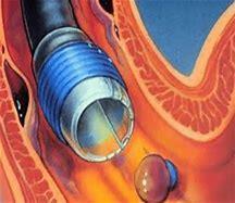 VARIZES ESOFÁGICAS Abordagem: 1-estabiliza 2-localiza 3-trata reduzir a pressão portal com vasoconstritor esplâncnico (terlipressina, somatostatina) mais ligadura elástica ou esclerose PROFILAXIA