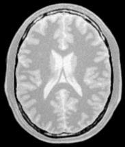 41 Figura 8: Exemplo de IRM do tipo PD. Fonte: o autor 2.